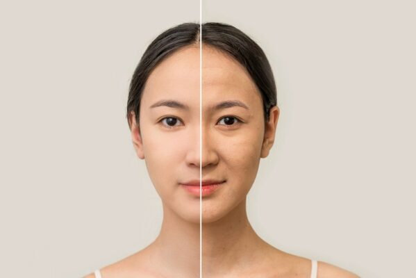 Hiệu quả của HIFU nâng cơ da mặt