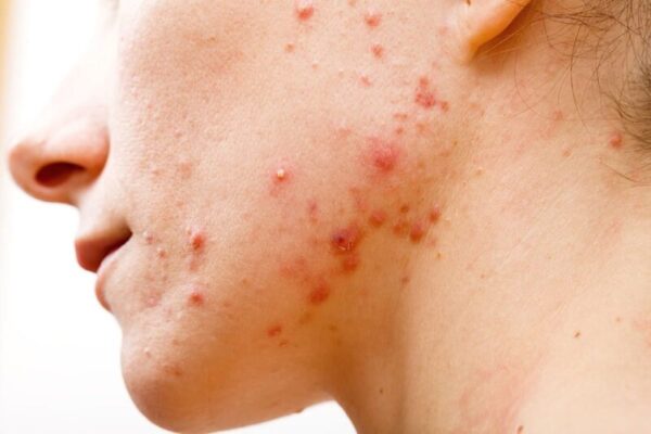 Đối tượng phù hợp và chống chỉ định với HIFU nâng cơ da mặt
