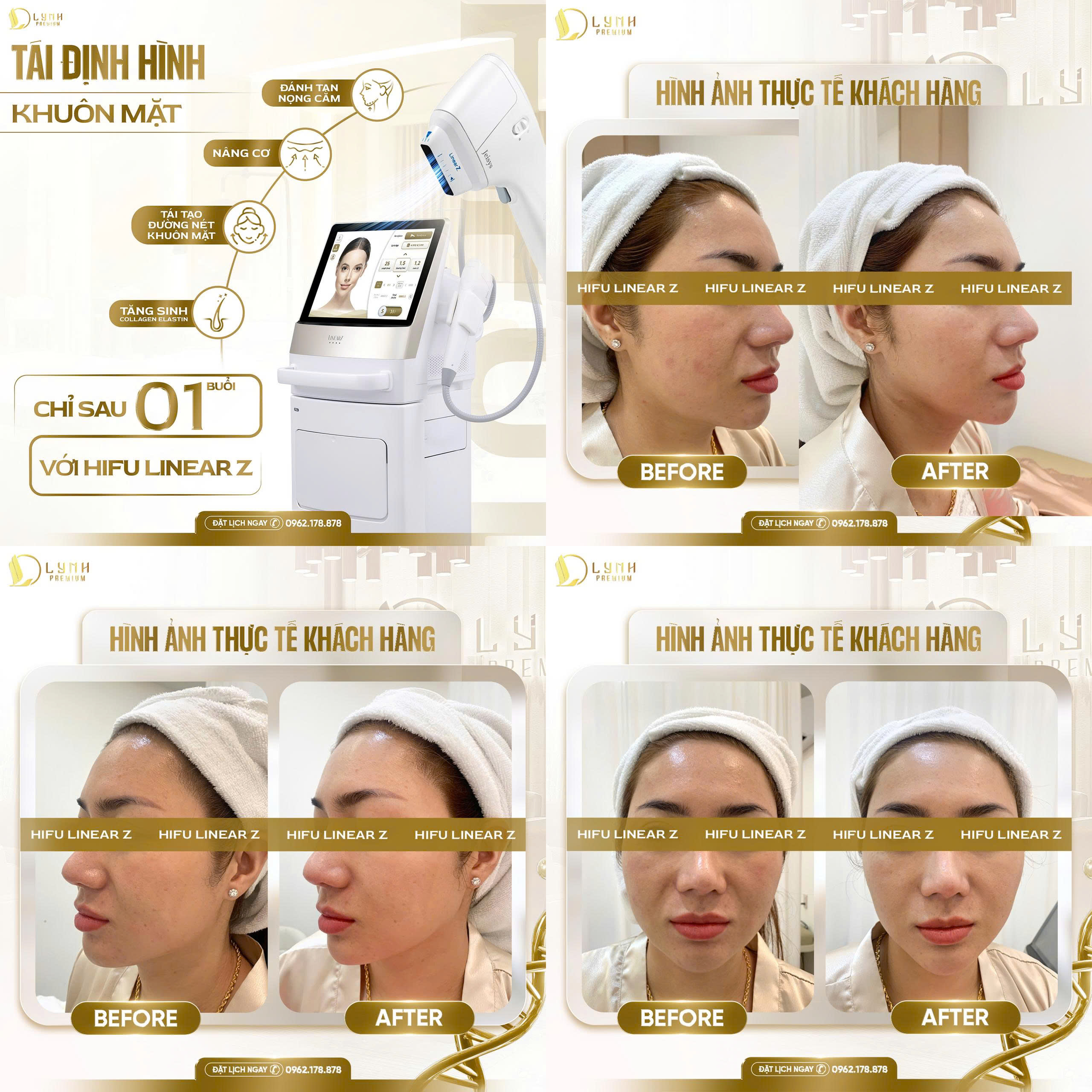 hifu linearz